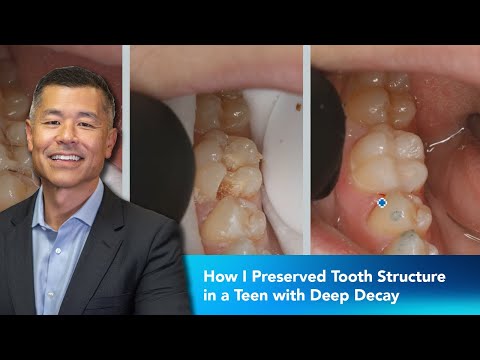 How I Preserved Tooth Structure in a Teen with Deep Decay | Dentist 2 Dentist - video from Vista Apex
