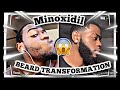 Minoxidil Beard - 5 Month Beard Transformation ( 2022 Update With Pictures)