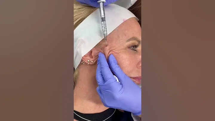 Full face filler transformation!