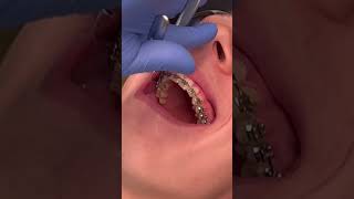 How easy it is to take off braces!