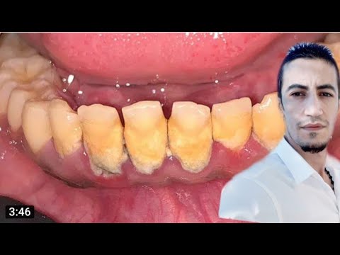 هل إزالة الجير من الاسنان يسبب ضعف المينا واللثه وماذا يحدث اذا لم يتم تنظيفه مهم انك تعرف