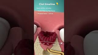 🩸 When does the blood clot form after a tooth extraction? Faster than you think.
