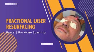 Rejuvenescimento facial com laser fracionado Fraxel Para cicatrizes de acne Dr J
