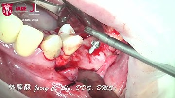 Incision, flapping & tenting for vertical ridge augmentation with Ti-reinforced dPTFE technique