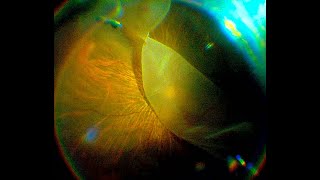 (3D) Vitrectomy for the Management of a Giant Retinal Tear