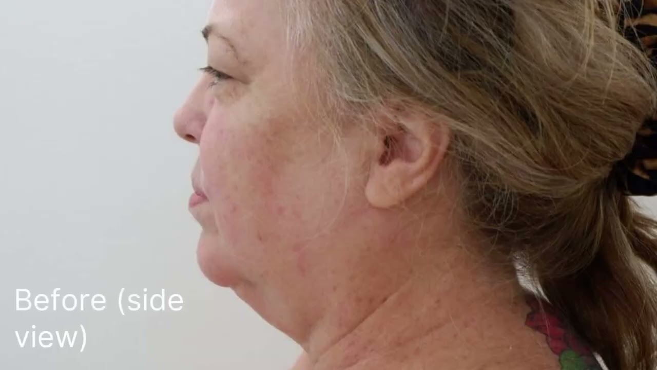 Deep plane facelift watch Ann in Bangkok 21 days post operation