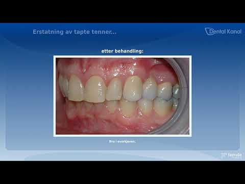 Video: Basal Tannimplantasjon Av Høy Kvalitet