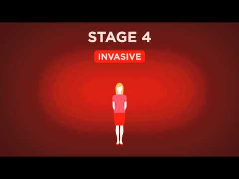 Beyond The Shock - Chapter 5 -  Types & Stages - Stage 4 Breast Cancer