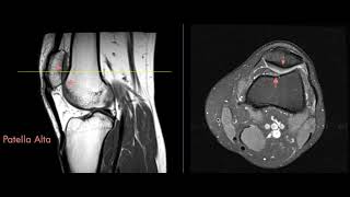 Patella Alta and Patella Baja