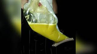 TUTORIAL MEMBERSIHKAN DAN MENGGANTI KANTONG COLOSTOMY