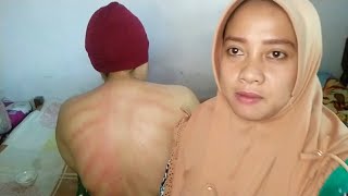 Kerokan wanita mbak Nur