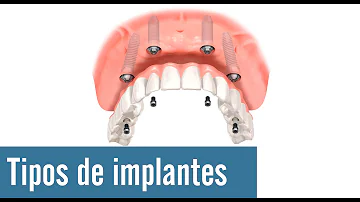 ¿Cuál es el implante dental más común?