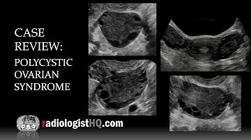 Ultrasound of Polycystic Ovarian Syndrome