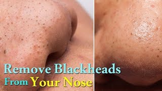 Blackhead Removal | Blackhead Mask | Blackhead Removal Mask | Nose Blackhead Removal | Blackheads