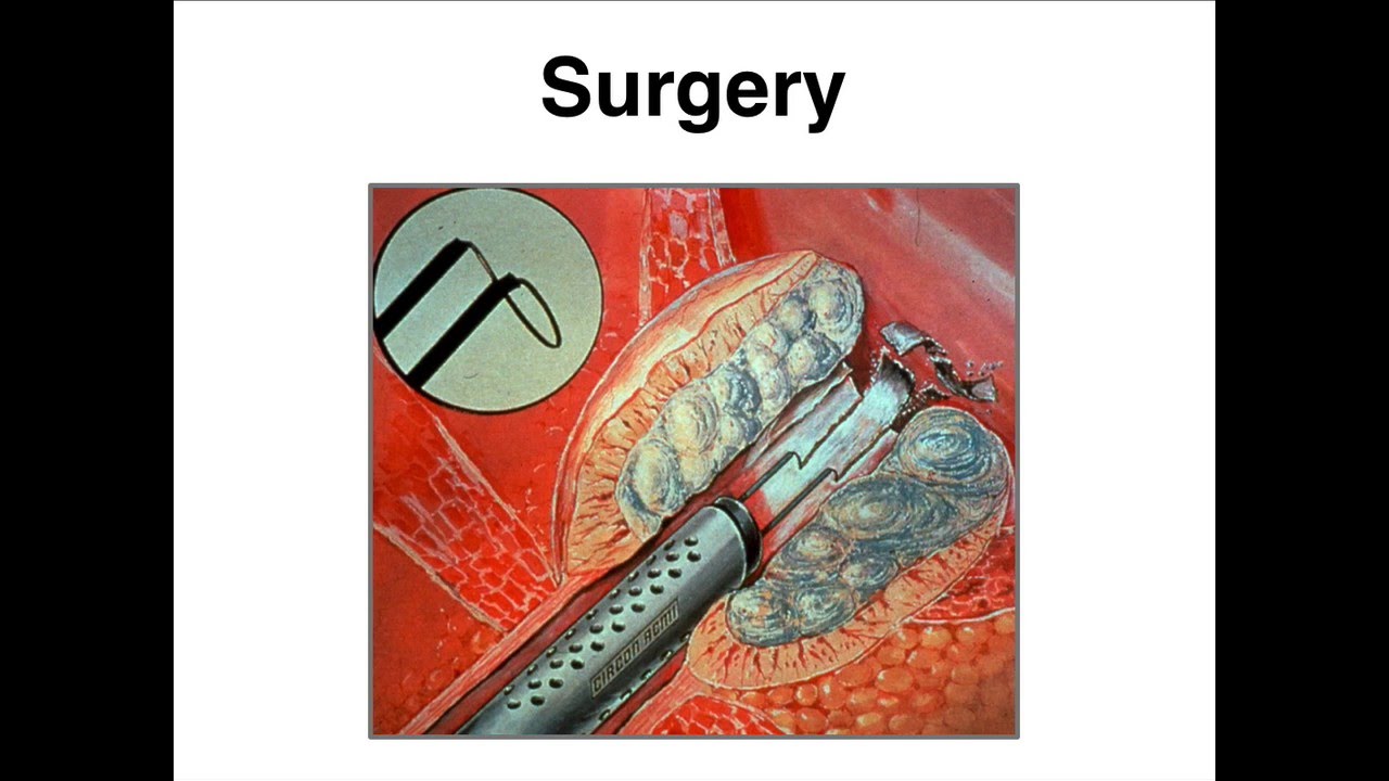 Chicago Metro SUNA Review: Prostate BPH Treatments