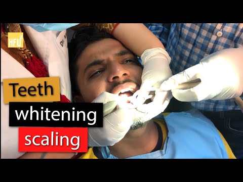 Dental Scaling & Teeth Whitening Procedure -cost, time, painless | With Dr Vriti Bajaj