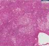 Histopathology liver alcoholic liver disease