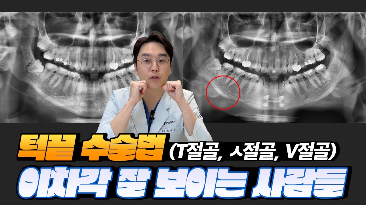 턱끝 전진술/후진술/축소술 후 생기는 이차각 해결방법은? (T절골, ㅅ절골, V절골)