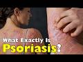 Why Does Psoriasis Happen? The Science Behind It