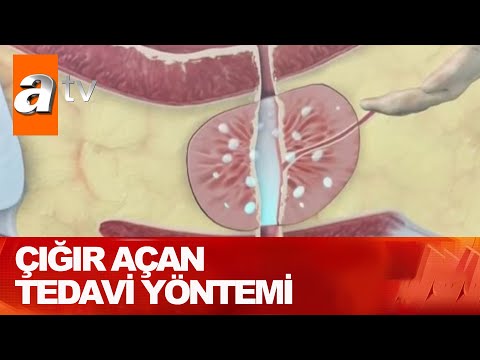 Prostatta ameliyat kabusu bitiyor - Atv Haber 22 Temmuz 2021