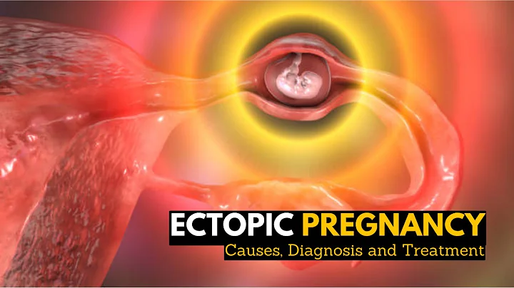 Ectopic Pregnancy, Causes, Signs and Symptoms, Diagnosis and Treatment. - DayDayNews
