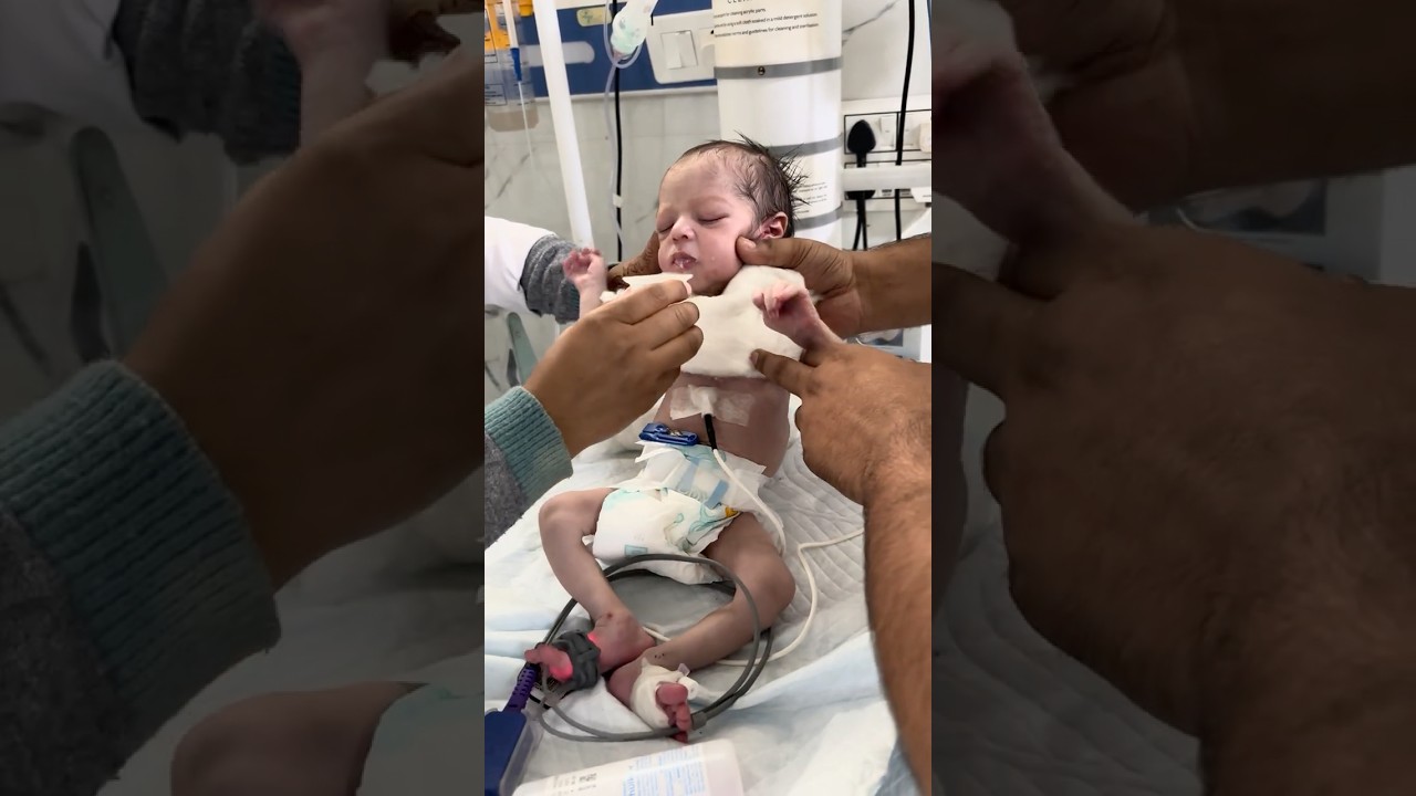 Feeding a Preterm Baby using Nifty Cup||| 