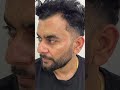 Best Pigmentation Result| Melasma Treatment | Crystal Skin Treatment | MedRootz Clinics #skincare n