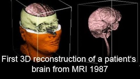 First 3D reconstruction of a patient‘s brain from MRI 1987