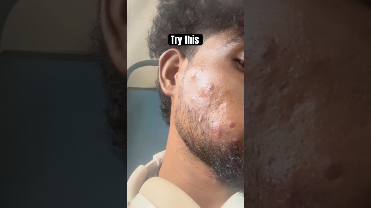 How to remove pimples? 