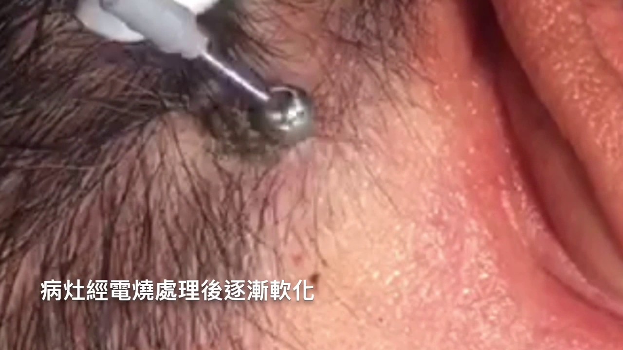 老人斑 頭皮大型脂漏性角化電燒 院長莊禮謙醫師美麗新城診所seborrheic Keratosis Warts 桃園中壢新竹苗栗台北基隆醫美除斑 Youtube