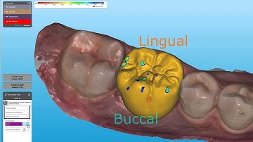 How to design and print a single unit crown with the iTero™ Design Suite | digital workflow tutorial