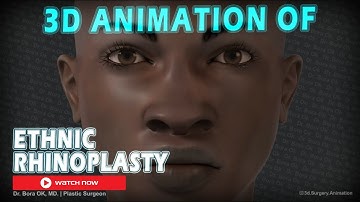 Dr. Bora Ok, MD. - 3D Animation Of Ethnic Rhinoplasty Surgery