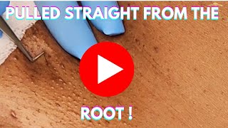 Ingrown Hair Extractions | Your Skin Talks, But Are You Listening? | Epi 73