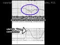 Umbilical Cord Prolapse and Hypoxic Ischemic Encephalopathy Cal Shipley, M.D.