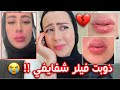 و اخيرا ذوبت الفيلر اللي موجود بشفايفي !! 😭 شوفوا شو صارلي 💔 || شهد ناصر 🌸