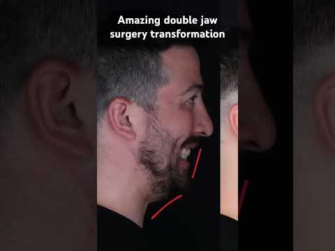 Before and after double jaw surgery for bite correction and sleep apnea treatment . Jawline enhanced