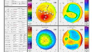 Clinical Correlation of Topography, Tomography, and OCT in Cornea Imaging. | AAO2 014
