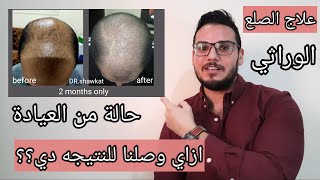 افضل نتيجة لعلاج الصلع الوراثي ؟  المينوكسديل ولا جلسات بلازما  ولا حقن أدوية ؟ امتي نزرع شعر؟