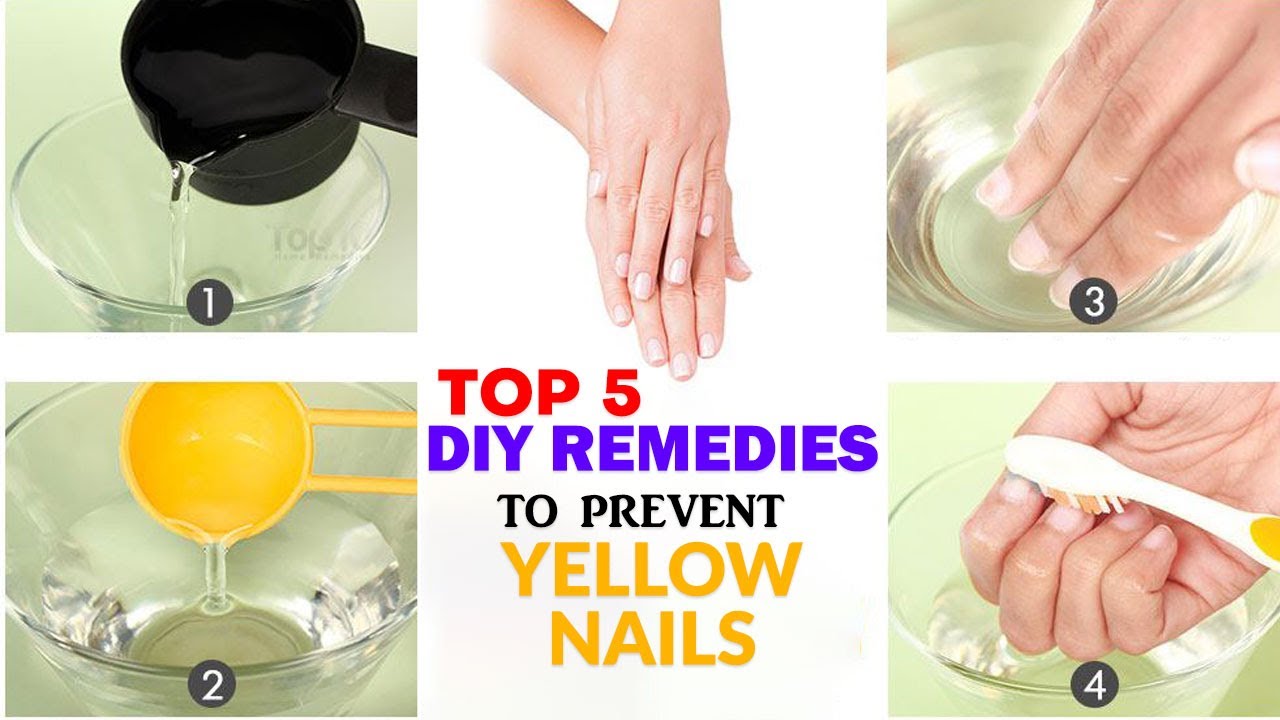 TOP 5 DIY Remedies To Prevent Yellow Nails || Beauty Tips & Tricks - YouTube