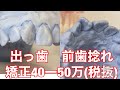 ３）前歯　出っ歯　捻れ八重歯　白いワイヤー矯正　安い費用値段　埼玉大宮鈴木歯科医院