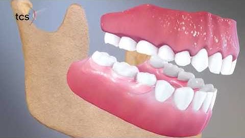 TCS Partial Dentures Animation Video