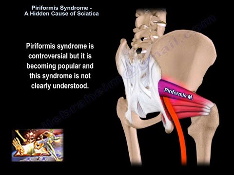 Piriformis Syndrome Symptoms, Diagnosis and Treatments