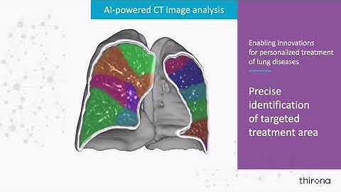 LungQ™ identification of targeted treatment area for preoperative planning