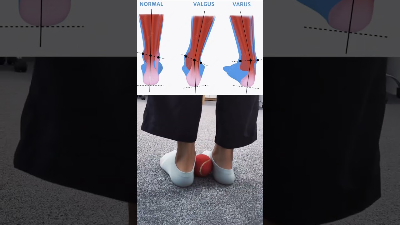Fix Knock Knees & Flat Feet at Home 🦵👣 | Physio-Approved Exercises 