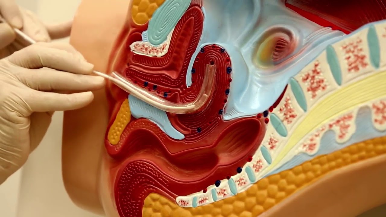 Biopsia endometrial com Cureta descartavel Pipelle de cornier.