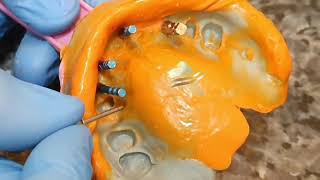 طب اسنان  طابع مفتوح  open tray dental impression طبعة لتعويض الأسنان بزرعات  فن العزف على الزرعات. screenshot 5