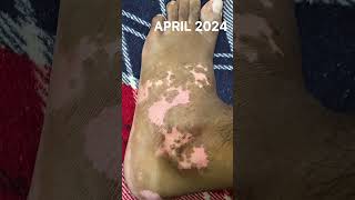 Vitiligo Left Ankle — 1 Year Recovery Journey | Real Monthly Proof