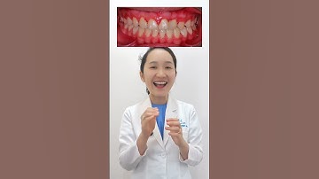 Bác sĩ có niềng răng cho bé bị hàm ếch không? #shorts