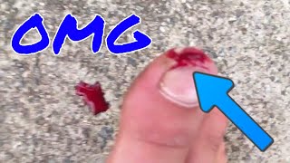 WORST STUBBED TOE EVER!! **graphic warning** (insane)