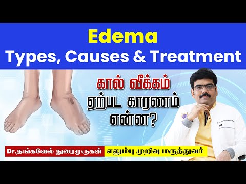 கால்வீக்கம் ஏற்பட காரணம் என்ன? Edema, Causes, Signs and Symptoms, Diagnosis and Treatment in tamil